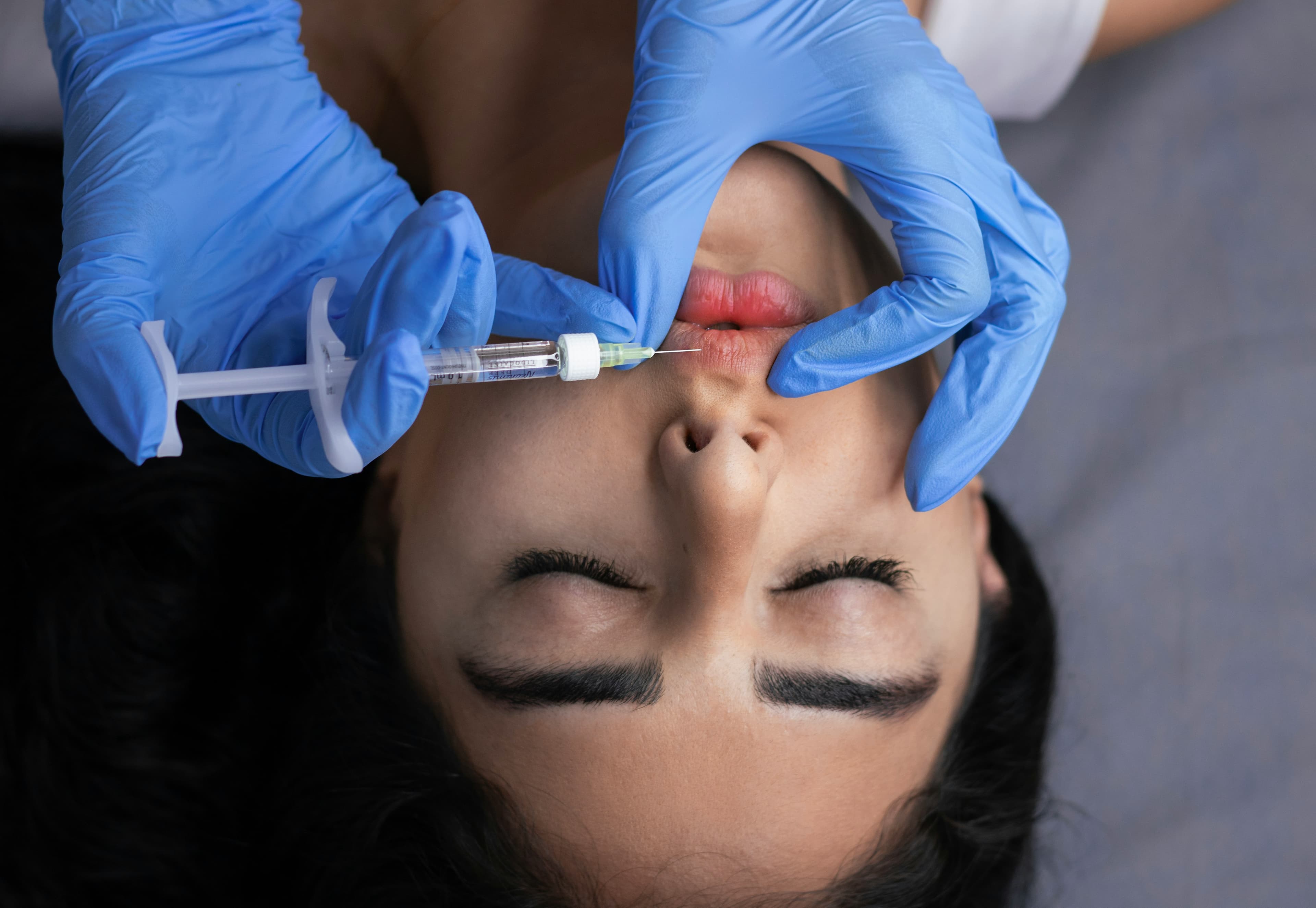 Lip Filler Migration and Risks: What to Know Before You Get Lip Filler